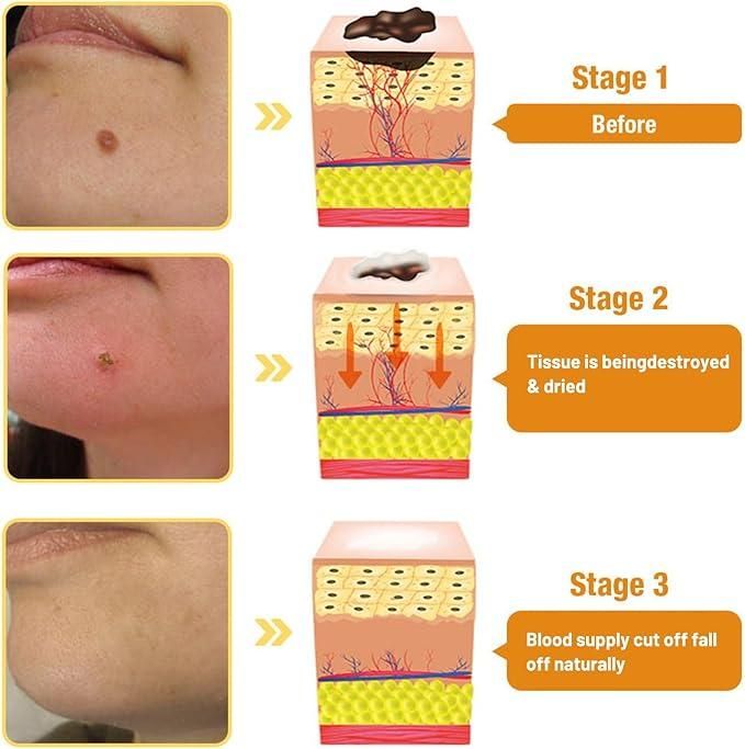 Bee Venom Wart & Mole Removal Cream