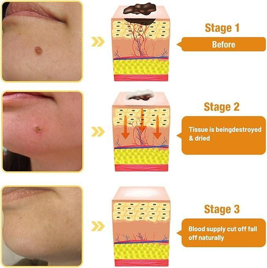 Bee Venom Wart & Mole Removal Cream